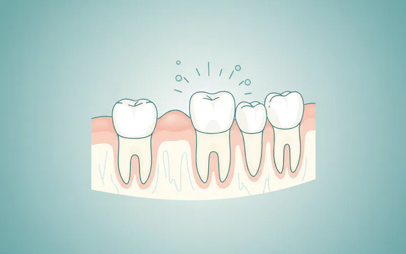 Illustration related to What Teething Is: An Overview of Tooth Eruption