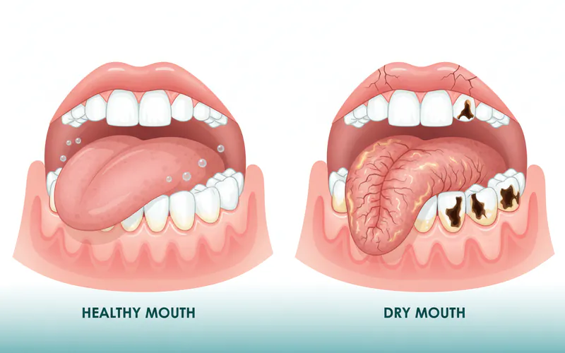 A diagram showing a healthy mouth with moist tissues and strong teeth contrasted with a dry mouth showing cracked lips, a red and fissured tongue, and visible tooth decay.
