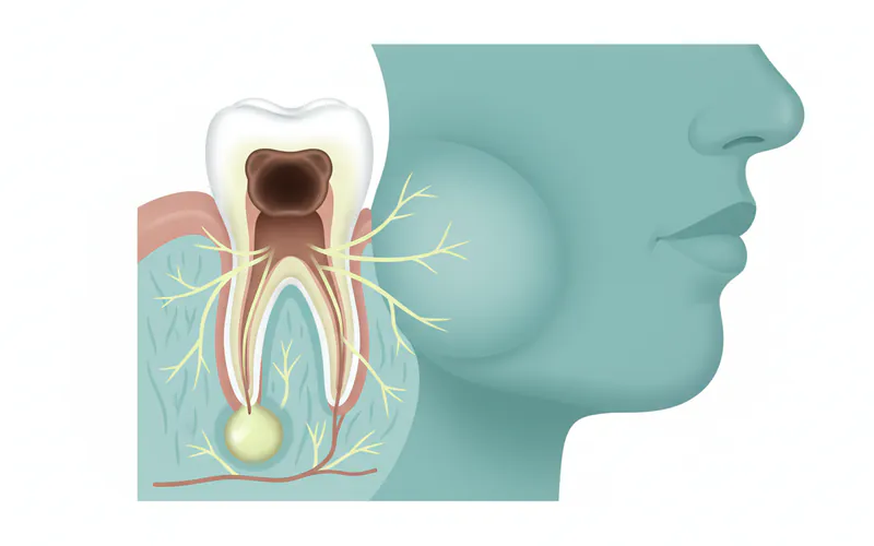 A diagram illustrating the progression of a dental infection from a deeply decayed tooth, showing how pus can accumulate at the root tip (abscess) and then spread outwards into the surrounding soft tissues of the cheek, causing visible facial swelling.