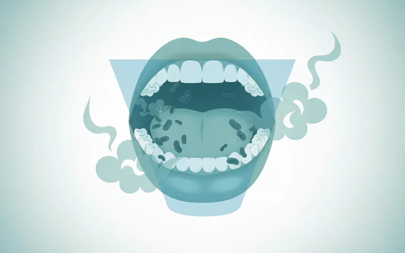 Illustration related to Halitosis: A Comprehensive Guide to Chronic Bad Breath