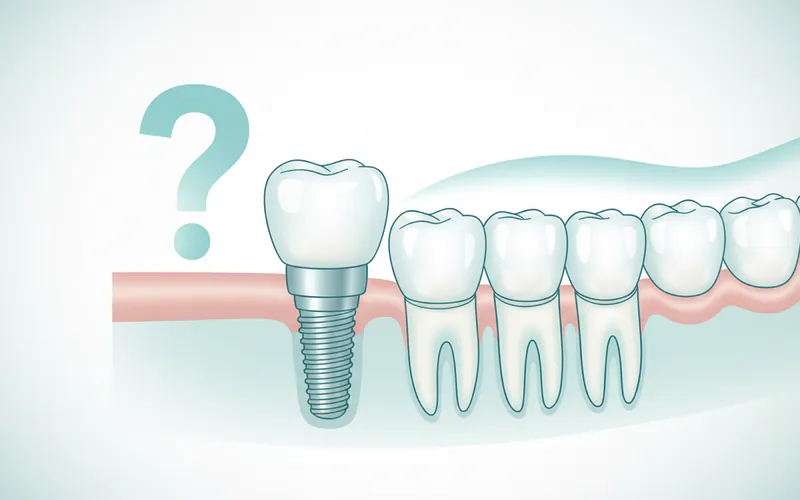 Illustration related to Implant: The Definitive Guide to Restoring Your Smile and Oral Health