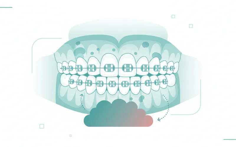 Illustration related to How much does orthodontic treatment hurt?