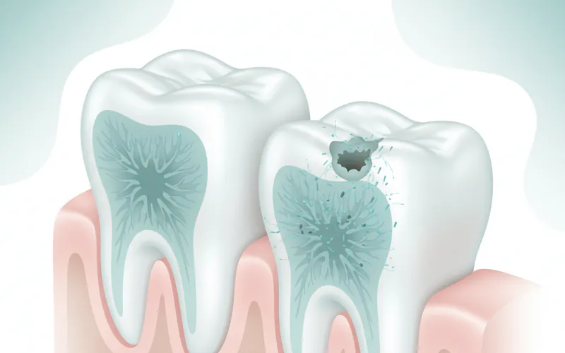 Illustration related to Why are posterior teeth more prone to cavities?