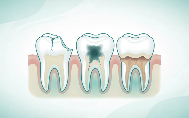 Illustration related to Common Issues Affecting Premolars