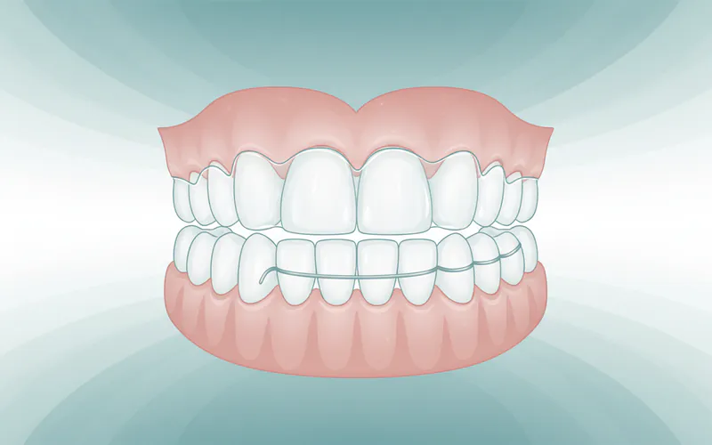 Illustration related to What is a Retainer: Your Definitive Guide to Maintaining Your Perfect Smile