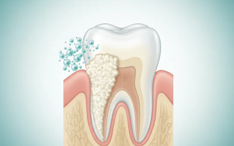 Illustration related to Tartar: The Hardened Threat to Your Smile