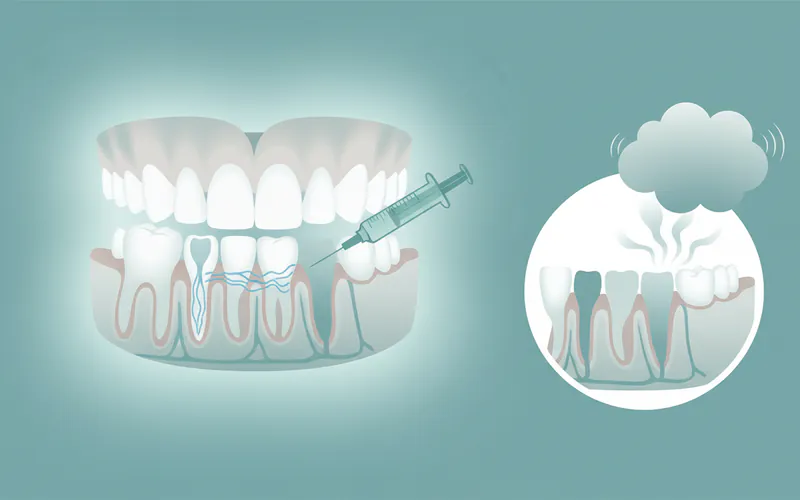 Illustration related to How painful is wisdom tooth extraction, and how long does the pain last?