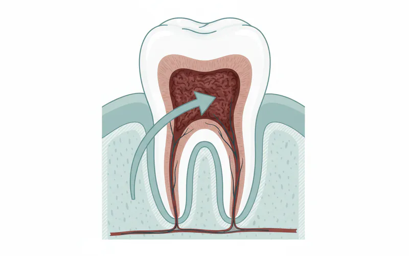 Detailed cross-section illustration of a tooth showing infected pulp, with an arrow pointing to the area targeted by root canal treatment.