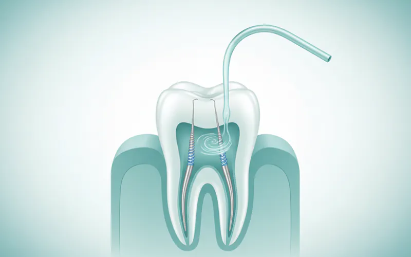 Medical illustration showing dental files cleaning out the root canals of a molar tooth, with irrigant being applied.