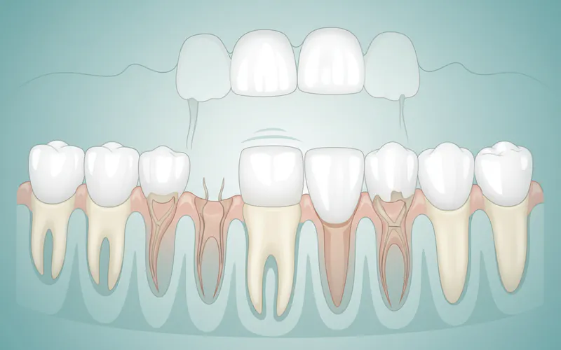 Illustration related to What It Is: The Natural Process of Losing Baby Teeth