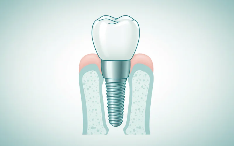 Diagram showing the components of a single dental implant (post, abutment, crown) placed in the jawbone.
