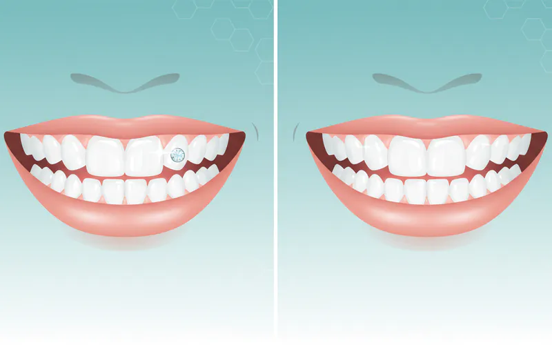 Before and after comparison showcasing a patient's smile with and without a professionally applied tooth gem, highlighting the pristine tooth surface after removal.