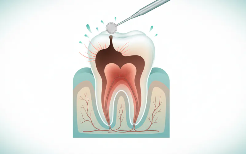 Illustration related to Nerve Damage