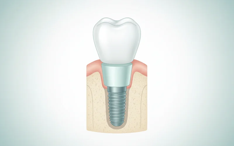 A detailed diagram showing the three main components of a dental implant: the titanium post embedded in the jawbone, the abutment connecting the post to the crown, and the visible dental crown on top.