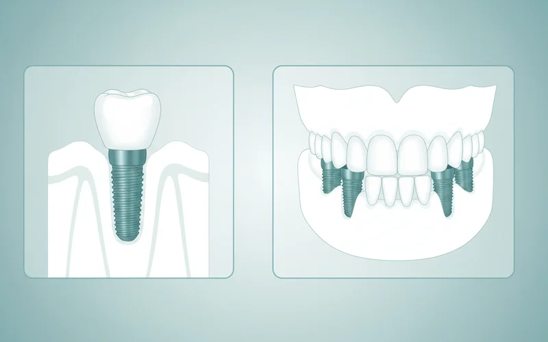 A comparative illustration showing a traditional single tooth implant versus an "All-on-4" dental implant system, highlighting the number of implants and the type of prosthesis they support.