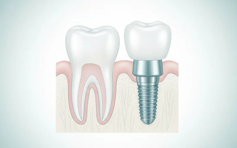 A detailed diagram showing the three components of a single dental implant (implant post, abutment, crown) placed within the jawbone, next to a healthy natural tooth for comparison.