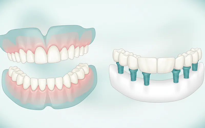 Comparison graphic illustrating a traditional full denture vs. an implant-supported full-arch bridge