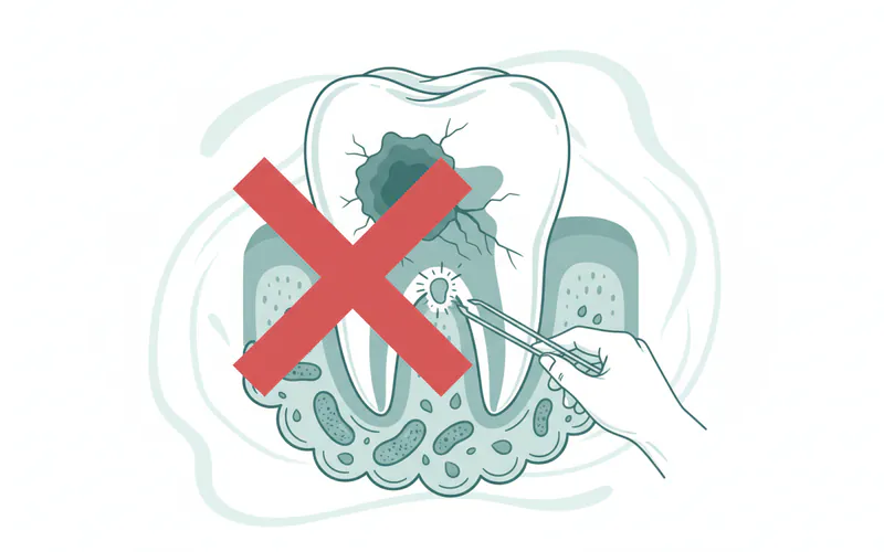 Illustration related to Can I really remove tooth decay myself?