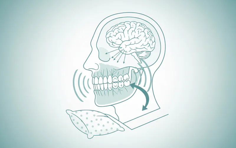 Illustration related to What Is Teeth Grinding at Night?