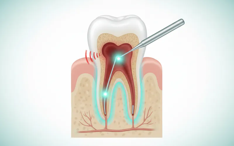 Illustration related to How to Stop Throbbing Pain After Root Canal: A Comprehensive Guide to Relief