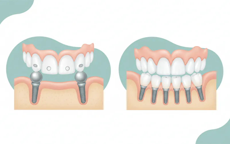 A diagram illustrating the difference between an implant-retained overdenture (showing two implants with snap attachments and a removable denture) and an implant-supported fixed bridge (showing 4-6 implants with a permanent, screwed-in full arch prosthesis).