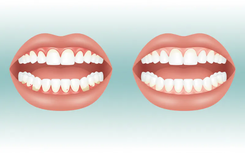 A before-and-after comparison showing visibly inflamed, red gums in a "before" image and healthy, pale pink gums in an "after" image.