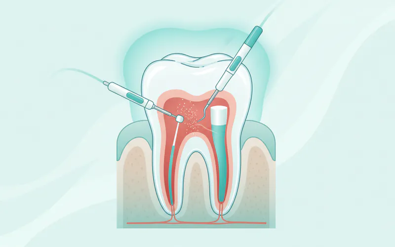 Illustration related to What is Root Canal Therapy? An Overview