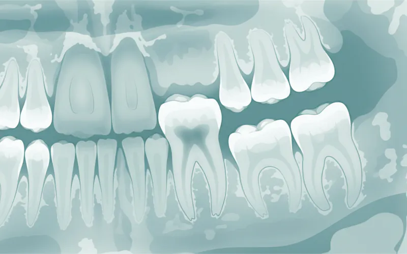 X-ray showing signs of root resorption around a replanted tooth