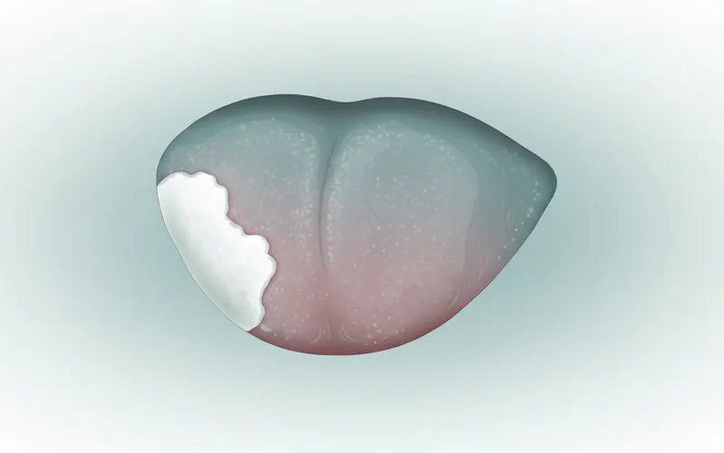 A close-up, medically accurate illustration of a human tongue showing a distinct, irregular white patch consistent with homogeneous leukoplakia on the lateral border.