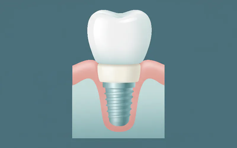 A cross-section diagram showing a molar implant placed in the jawbone with an abutment and crown, indicating the different components: implant post, abutment, and crown. It should also show the surrounding bone and gum tissue.