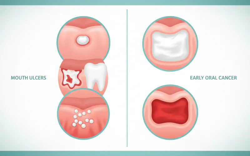 Visual comparison chart of various types of mouth ulcers (aphthous, traumatic, herpetic) vs. early oral cancer lesions (leukoplakia, erythroplakia)
