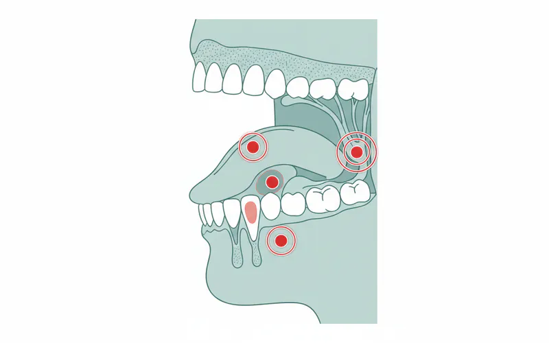 Detailed anatomical diagram of the mouth and oropharynx showing common sites of oral cancer, such as the lateral border of the tongue, floor of the mouth, and tonsil area, highlighted with small red circles or outlines.