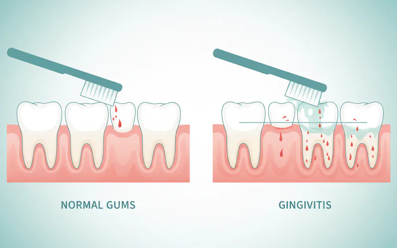Illustration related to Bleeding Upon Brushing/Flossing