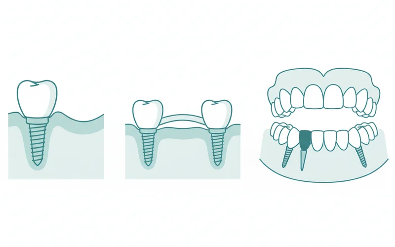 Diagram comparing a single implant, an implant-supported bridge, and an All-on-4 full arch restoration