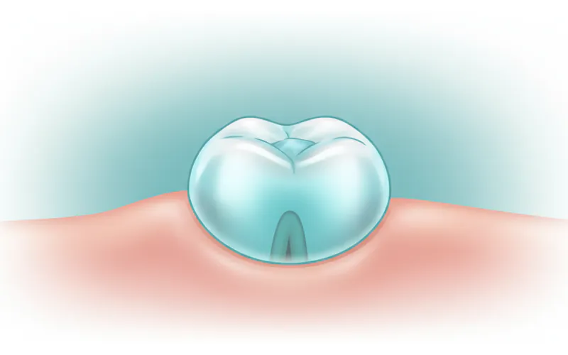 A close-up illustration of a child's gum showing a bluish, dome-shaped baby tooth eruption cyst over an emerging molar.