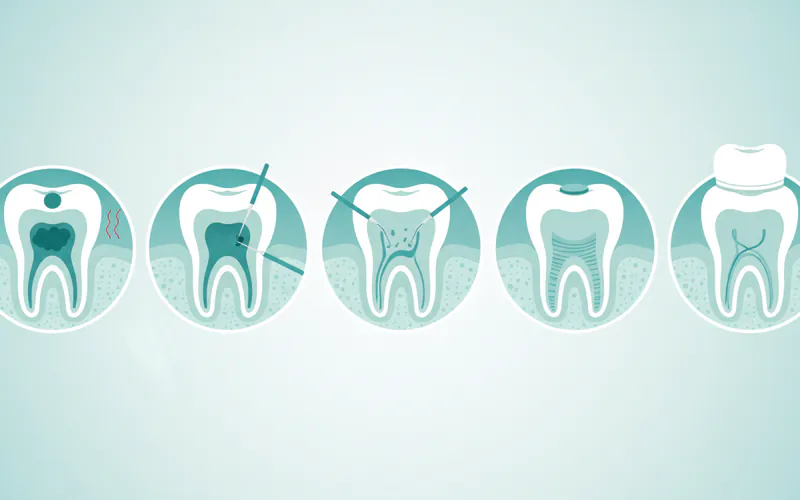 A cross-section diagram of a tooth showing the stages of a root canal procedure: 1) Initial infection in the pulp, 2) Access opening and pulp removal, 3) Cleaning and shaping of canals, 4) Filling with gutta-percha and sealing, 5) Final crown restoration.