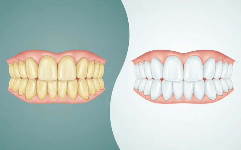 Before-and-after image of teeth with severe acid erosion. "Before" shows yellowed, shortened, and cupped teeth. "After" shows teeth restored with crowns or veneers, appearing whiter, longer, and aesthetically pleasing.