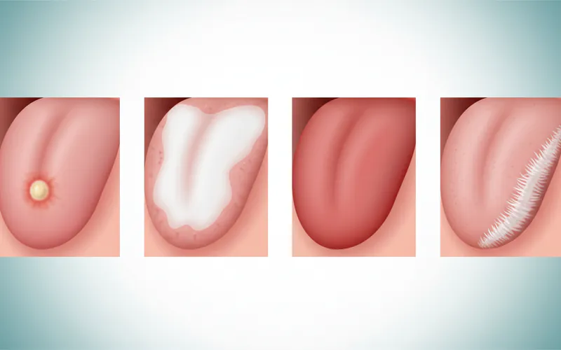 A comparison image showing different types of oral lesions: a typical canker sore, a white leukoplakia patch, a red erythroplakia patch, and an oral hairy leukoplakia lesion on the side of the tongue.