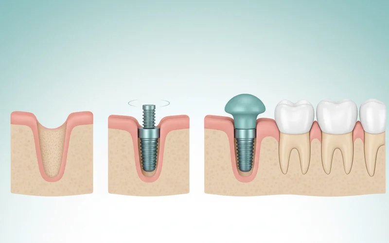 A series of four progressive images showing the dental implant process: 1. A missing tooth with visible jawbone. 2. An implant screw being placed into the jawbone. 3. The healing abutment attached to the integrated implant. 4. The final crown cemented onto the abutment, completing the restoration.