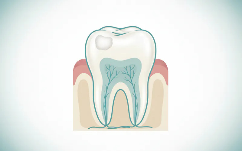 Illustration related to What does a stage 1 early cavity look like?