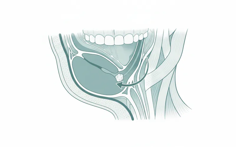 Medical illustration showing the location of the submandibular salivary gland and Wharton's duct, with an arrow pointing to a salivary stone obstructing the duct.