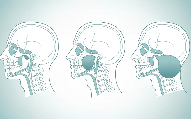 A medical illustration depicting the stages of airway obstruction due to severe sublingual swelling, showing the tongue being pushed upwards and backwards.
