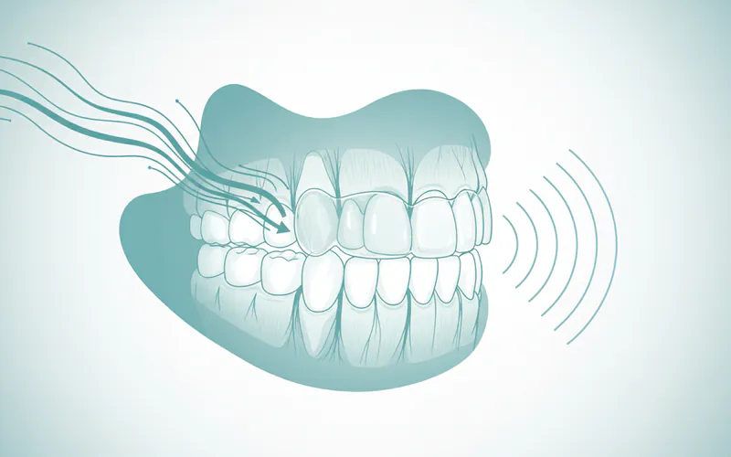 Illustration related to Prevention of Teeth Clenching and Grinding