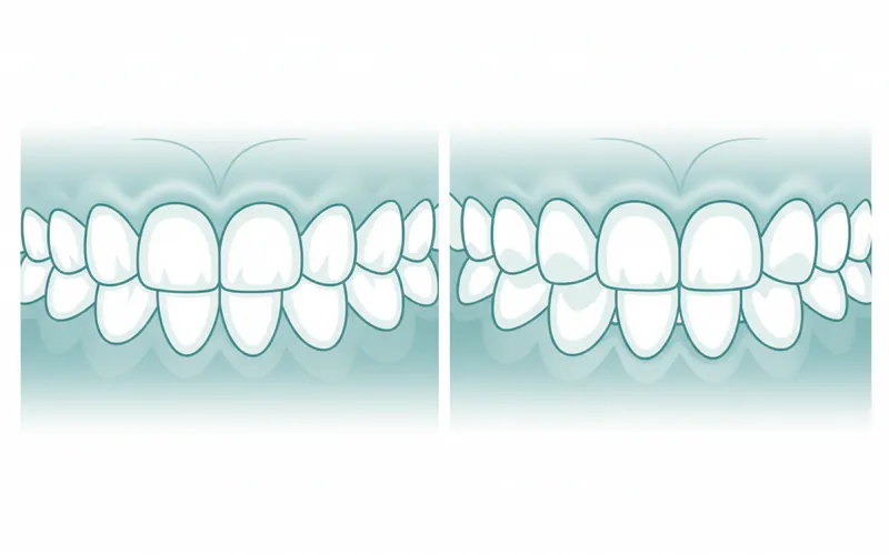 illustration of a toddler's teeth showing normal wear vs. excessive wear from bruxism, highlighting flattened cusps