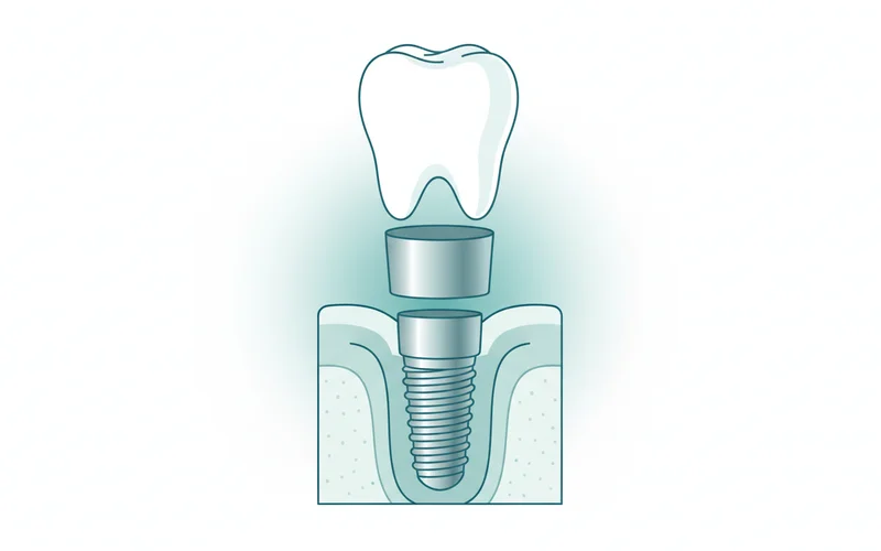 Diagram showing the three components of a dental implant: implant post, abutment, and crown, clearly labeled.