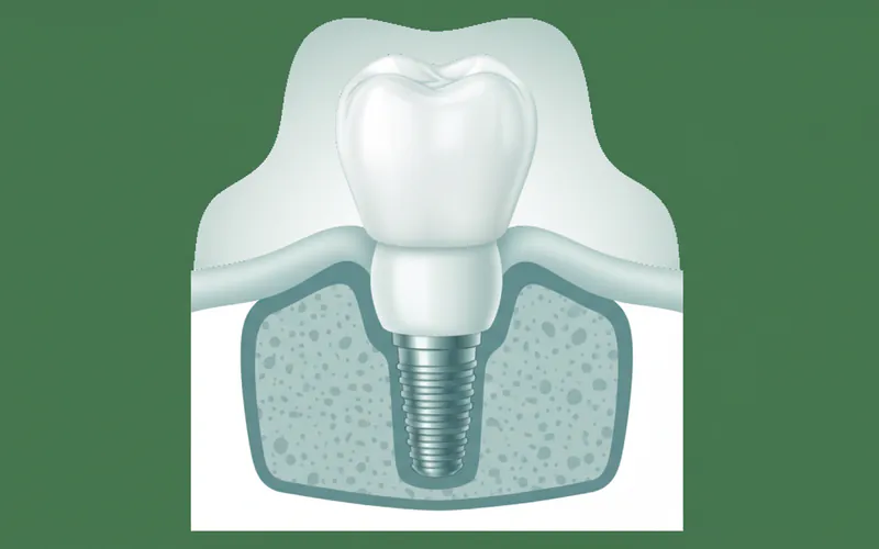 Diagram showing implant components: titanium post, abutment, and custom crown attached to the abutment, all within the jawbone and gum line.