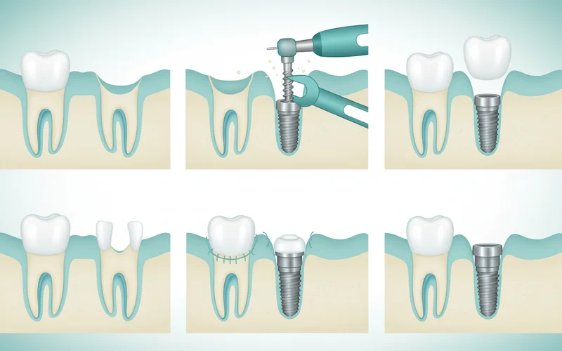 A series of illustrations showing the step-by-step process of a single dental implant placement: 1) Missing tooth with jawbone. 2) Incision and drilling a pilot hole. 3) Inserting the titanium implant screw into the jawbone. 4) Gum tissue sutured over the implant, showing the healing cap. 5) Later stage with abutment attached. 6) Final crown placed on the abutment.