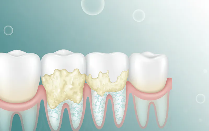Illustration related to What Are Calcium Deposits on Teeth