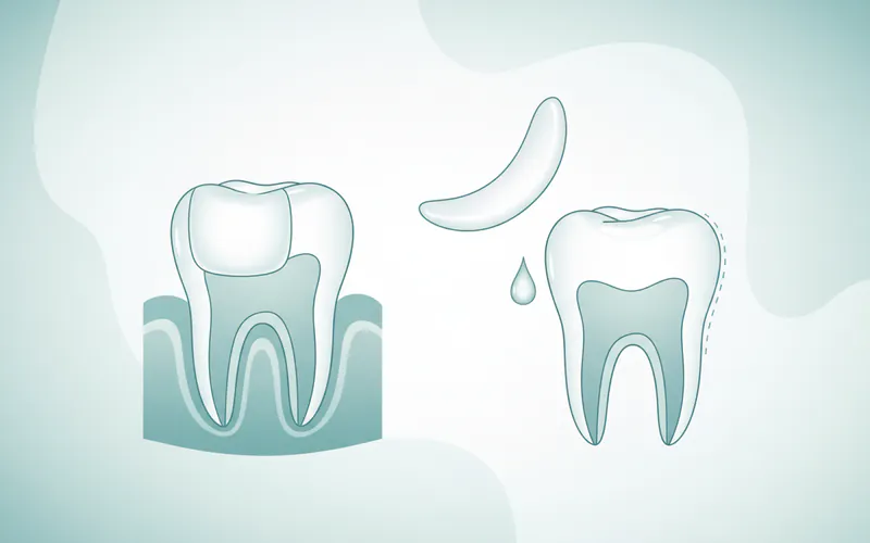 Illustration related to What Are Veneers? An Overview