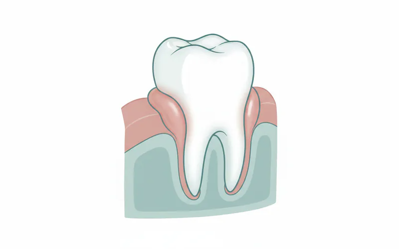Illustration related to What It Is: Understanding Gum Swelling